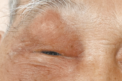 84歲的李爺爺半個月前突然右眼腫脹,2周後出現疼痛、影響視野,就醫診斷為急性鼻竇炎併發右眼上皮膿瘍。(台北慈濟醫院提供/王家瑜台北傳真) image