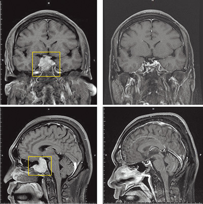 腦瘤壓迫變易怒 新微創手術除瘤無開顱